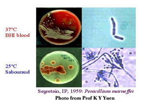 Bệnh do nấm Penicillium Marneffei 