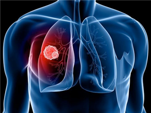 Bệnh ung thư phổi – Những điều cần biết